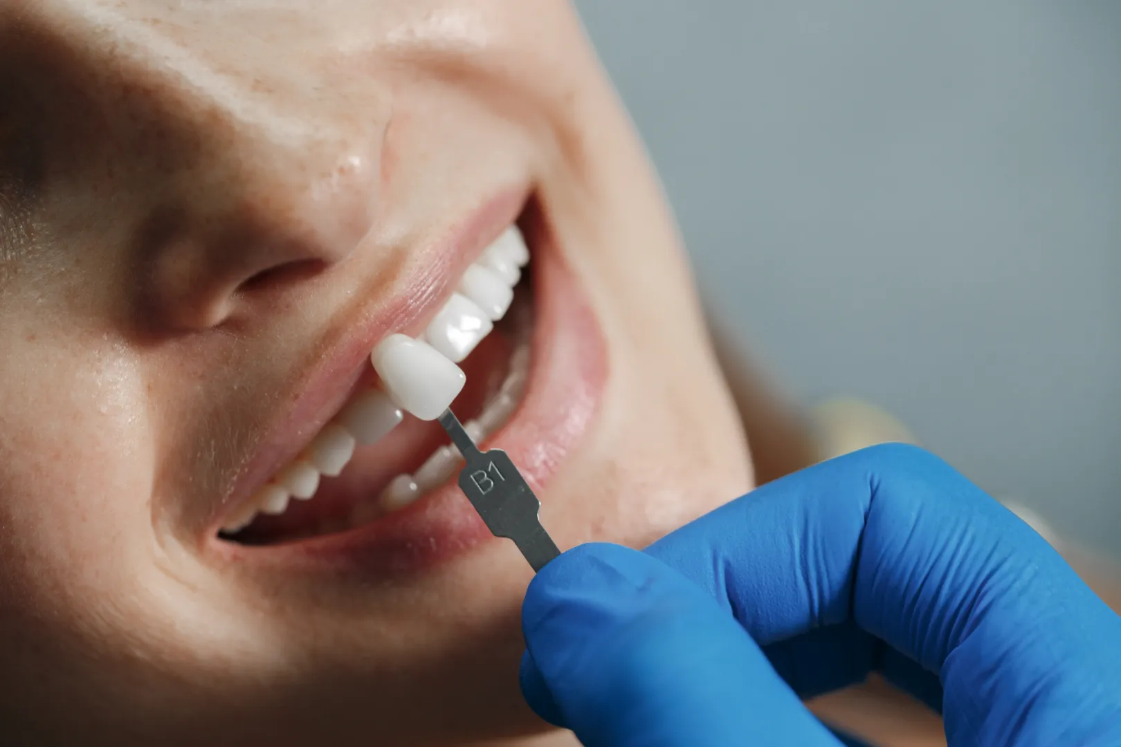 Lentes de contato dental: quem pode fazer e quanto custa